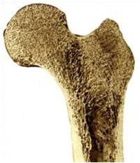 Osteoporose